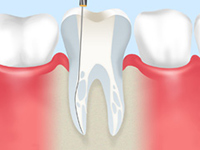 重度のむし歯は根管治療で治しましょう