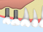 インプラント埋入