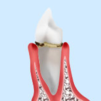 歯肉炎・軽度歯周病