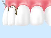 スケーラーで歯周ポケットや歯と歯の間に付着したプラークや歯石を除去します