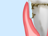 キュレットという器具を使い、歯周ポケットにこびりついたプラークや歯石を除去します