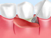 局部麻酔をした後、歯周ポケットの中のプラークや歯石、膿を取り除きます