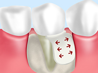 人工骨や自分の骨を移植し、骨量を増やす再生治療です