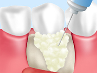 骨の再生を促す方法です